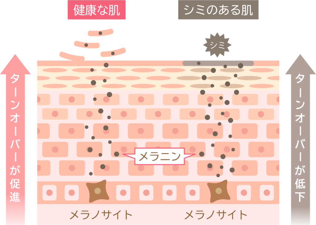 ターンオーバーの遅れがシミにつながる